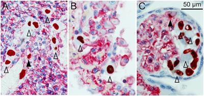 In vivo Downregulation of MHC Class I Molecules by HCMV Occurs During All Phases of Viral Replication but Is Not Always Complete